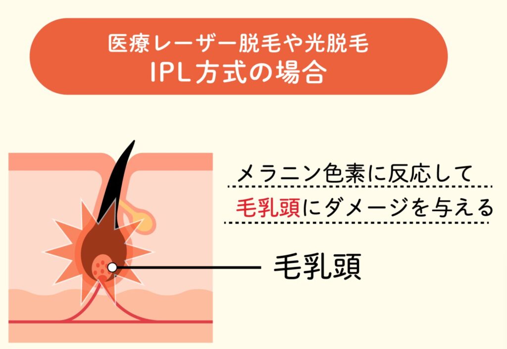 脱毛は「黒いメラニン」に反応してダメージを与える